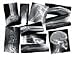 Broken bone, compound fracture x-rays