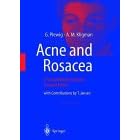 Acne and Rosacea