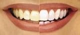 1ml 22% Professional Bleaching Gel, BUY 2 GET 2 Free!
