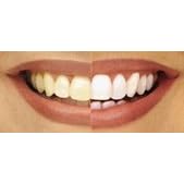1ml 22% Professional Bleaching Gel, BUY 2 GET 2 Free!