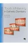 Tooth Whitening in Esthetic Dentistry: Principles and Techniques