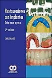 RESTAURACIONES CON IMPLANTES (Spanish Edition)