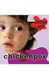 Chicken pox