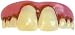 Megabucks Teeth - Billy Bob(R)