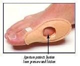`Bunion Shield Universal Absorbs both pressure and friction over the bony prominence of hallux abduc
