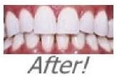 INSTANT WHITE SMILE'S optimized 10cc 36% Carbamide Peroxide Teeth Whitening Gel syringe with Remineralization Gel -no trays