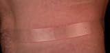 Rejuvaskin 10112 Surgical Scar Removal 