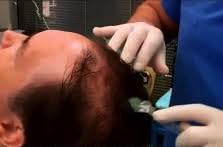 CAPILIA SANA - DOKTORDERMA HAIR MESOTHERAPY MULTI-VITAMIN/MINERAL COCKTAIL PACK (3 month treatment)