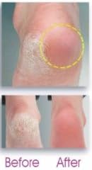 Electric Callus Shaver - Eliminator - Remover Heel Treatment Pedicure Tool Malvern Mfg