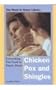 Everything You Need to Know About Chicken Pox and Shingles (Need to Know Library)