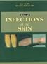 Atlas of Infections of the Skin, 1e