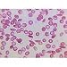 Human Pathology Anemia (Human)