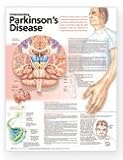 Understanding Parkinson's Disease Anatomical Chart Paper Unmounted