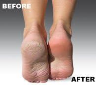 Emjoi Micro-Pedi Refill Rollers (Super Coarse) - Pack of 4