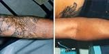 Tattoo Remover Kit