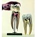 Somso Molar With Caries