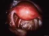 Endoscopy, Panorama of Uterus, Tubes, Ovary Right Photographic Poster Print, 40x30