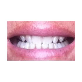 Crest 3D White 2-Hour Express Whitestrips Dental Whitening Kit