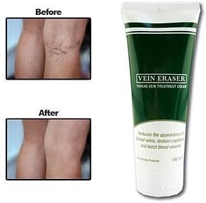 Vein Eraser Cream by Verseo