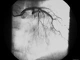 Cardiac Cath, Angiogram 99% Stenosis, Coronary Artery Photographic Poster Print, 16x12