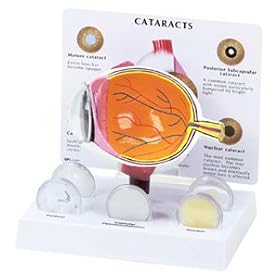 Click here to buy Cataract Eye, Anatomical Model, Set of 5 Interchangeable Lens by Lake Forest Anatomicals Eye Models.