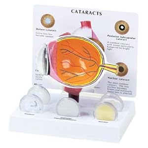Cataract Eye, Anatomical Model, Set of 5 Interchangeable Lens by Lake Forest Anatomicals Eye Models