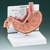 Stomach with Ulcers Model