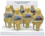 4-Stage Osteoarthritis Knee Joint Model