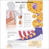 High Cholesterol Anatomical Chart Laminated