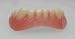 Billy Bob Secure Smile Teeth- Lower Veneers