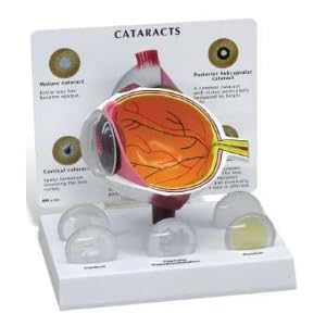 Cataract Eye Model by Anatomical Chart Company