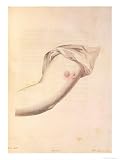 Arm of William Pead Used For Smallpox Vaccine Art Giclee Poster Print by William Skelton, 18x24