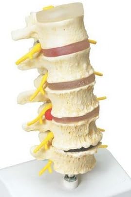 Anatomical Innovations 903 Spine Model – stages of disc prolapse and vertebral degeneration