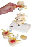 Stages of disc prolapse and vertebral degeneration Model