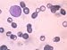 Acute Granulocytic Anemia Immature White Blood Cells Photographic Poster Print, 16x12