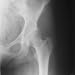 X-Ray Normal Pelvis Acetabulum Head of Femur Photographic Poster Print, 16x16