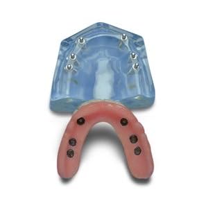 Upper Arch--Overdenture implant supported by