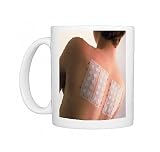 Young woman with allergy test patches on her back Photo Mugs