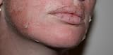 #1 TOP SELLING BRAND FOR CHEMICAL PEELS TWO  70% Glycolic Acid Strength Pure Medical Grade Chemical Peel Solution
