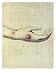 Cowpox Pustule on the Arm of Sarah Nelmes Art Giclee Poster Print by William Skelton, 18x24