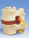 2 Lumbar Vertebrae Model with prolapsed disc, flexibly mounted