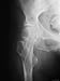 Human Female Hip Joint X-Ray, Osteoporosis Photographic Poster Print, 12x16