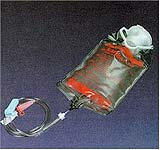 Bag Kangaroo Non Sterile Enteral Feeding Pump Set And 500ml Easy Cap