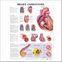 Heart Conditions Anatomical Chart 20" X 26"