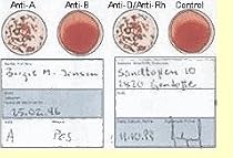 Blood Type Kit - Also Includes: 1 Eldoncard, 1 lancet, gauze, alcohol wipe, micropipette