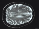 Brain Tumor, MRI White Patches Photographic Poster Print, 32x24