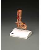 Esophagus Anatomical Model with Reflux & Ulcer Disease