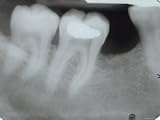 X-Ray of Wisdom Tooth and Molars in Mouth Photographic Poster Print, 18×24