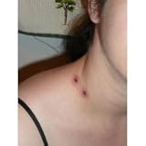 Vampire Bites