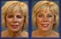Bring It Up - Instant Face Lifts (Brow and Neck)